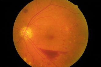 Recent Developments in Retinal Disease