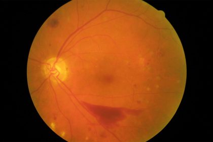 Recent Developments in Retinal Disease