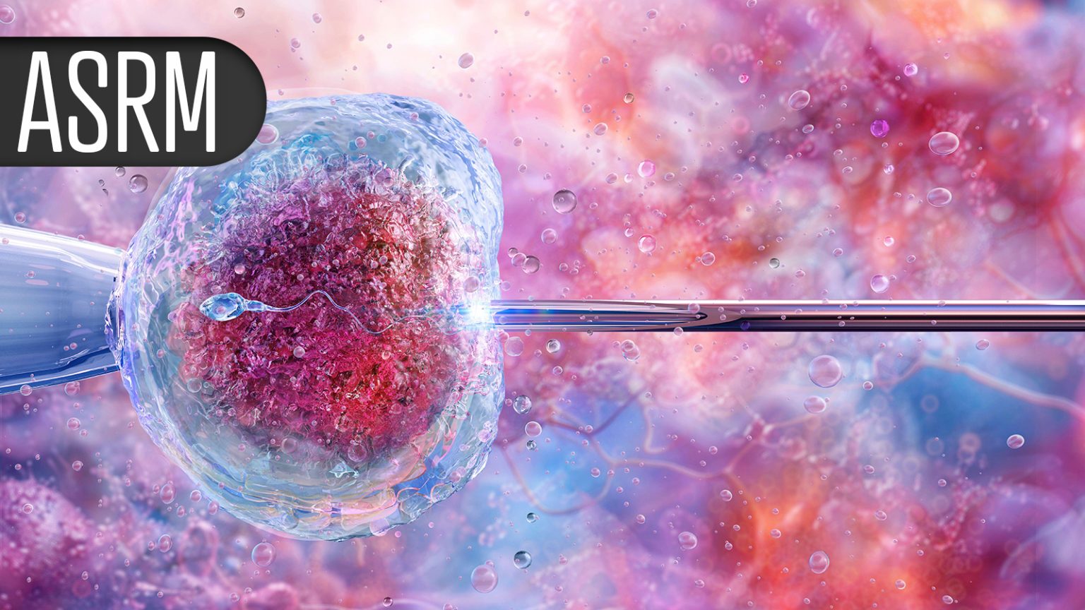 NSAID Infusion Eases Pain of Egg Retrieval, Cuts Narcotic Use