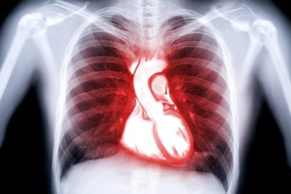 Comprehensive Testing Improves Angina After MINOCA