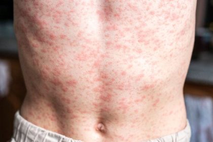 PAHO calls for regional action as the Americas lose measles elimination status