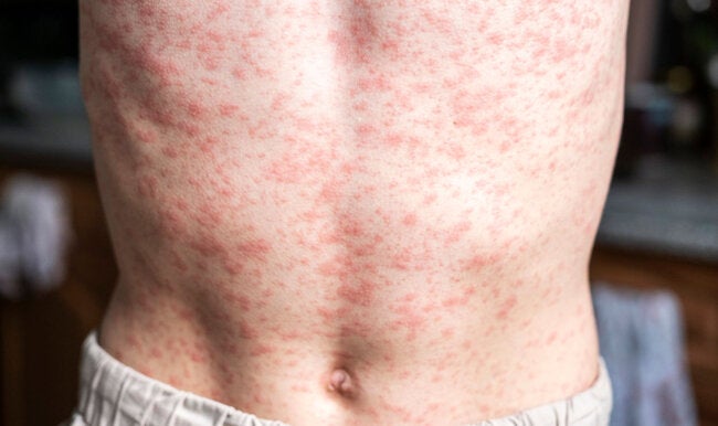 PAHO calls for regional action as the Americas lose measles elimination status