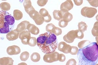 Benralizumab Shows Benefits for Hypereosinophilic Syndrome