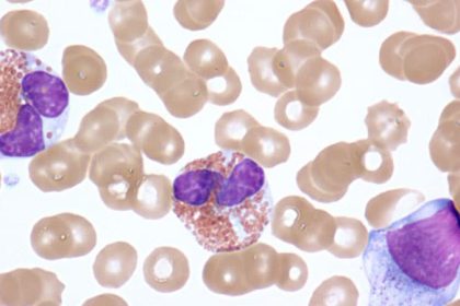 Benralizumab Shows Benefits for Hypereosinophilic Syndrome