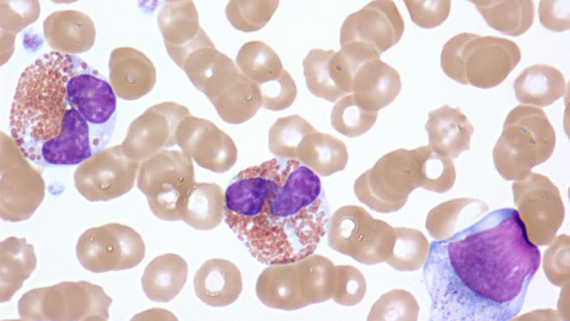 Benralizumab Shows Benefits for Hypereosinophilic Syndrome