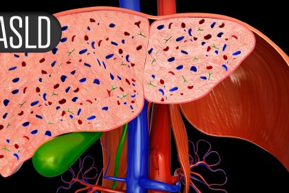 After Hepatitis C Cure, MASLD May Boost Liver Cancer Risk