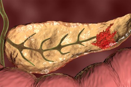 Study Links Chronic Hep C to Risk of Deadly Cancer