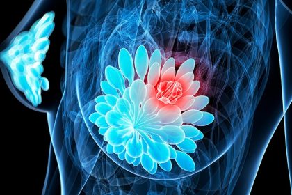 Europe Moves Forward With ESR1-Driven Breast Cancer