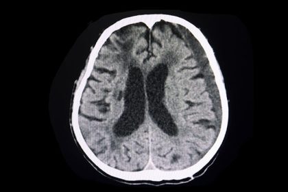 Benefit of Embolization for Subdural Hematoma Confirmed