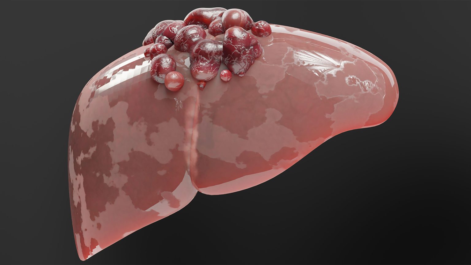 Liver Cancer Treatment Landscape Shifts Rapidly, but Best Sequencing Still Unclear