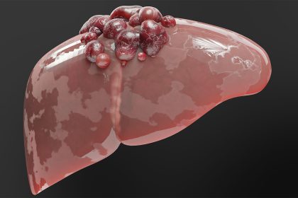 Liver Cancer Treatment Landscape Shifts Rapidly, but Best Sequencing Still Unclear