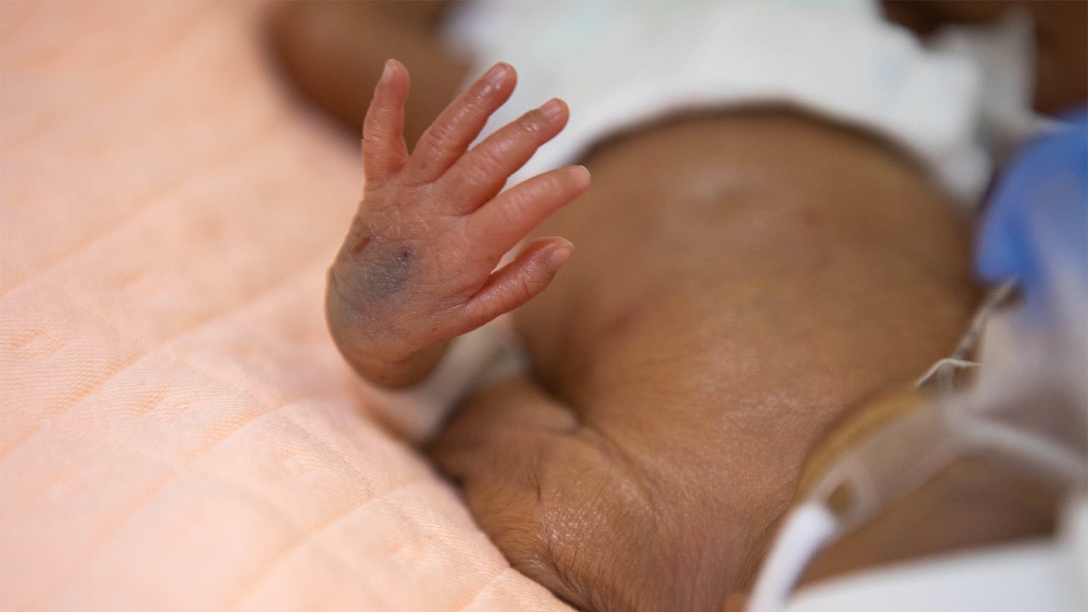 Preterm Birth Rates Rise in Low-Income Households