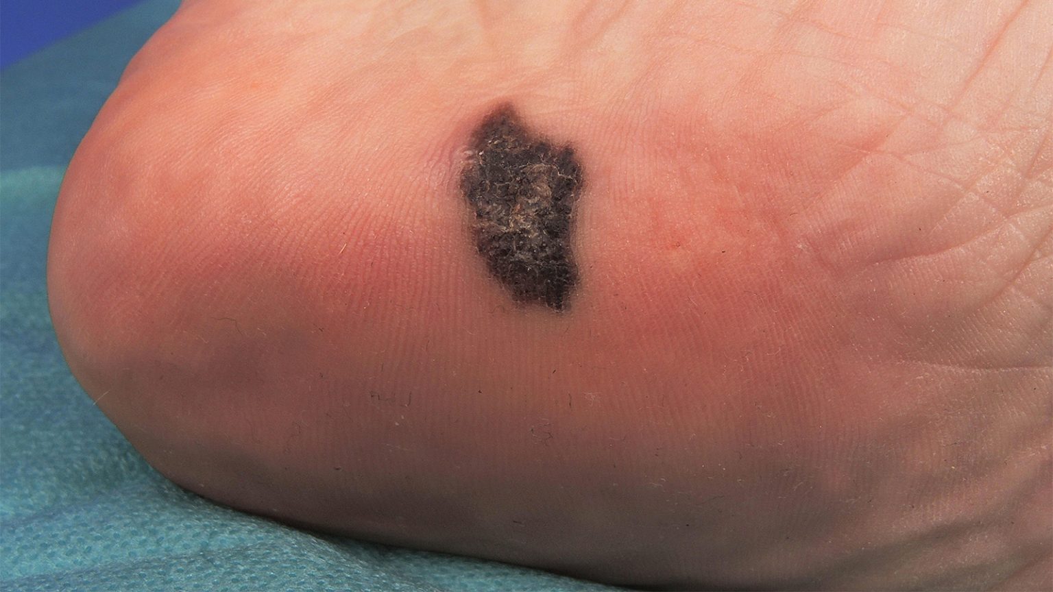 PD-1 Inhibitor Raises PFS in Advanced Acral Melanoma