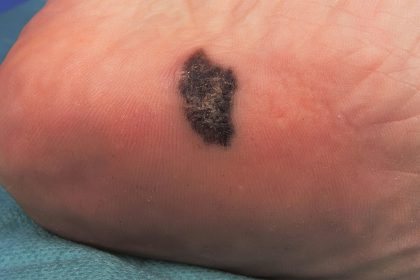 PD-1 Inhibitor Raises PFS in Advanced Acral Melanoma