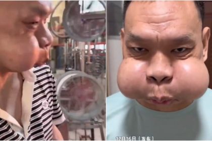 कांच की फैक्ट्री में 30 साल किया काम… अब मेंढक की तरह हो गया शख्स का चेहरा