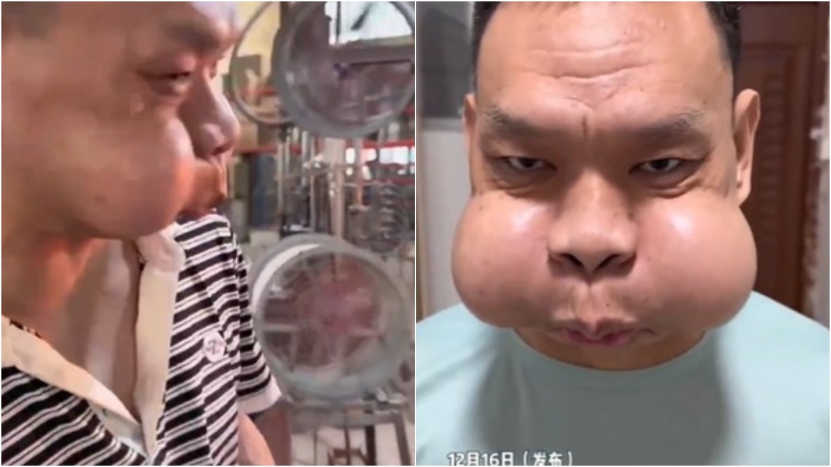 कांच की फैक्ट्री में 30 साल किया काम… अब मेंढक की तरह हो गया शख्स का चेहरा