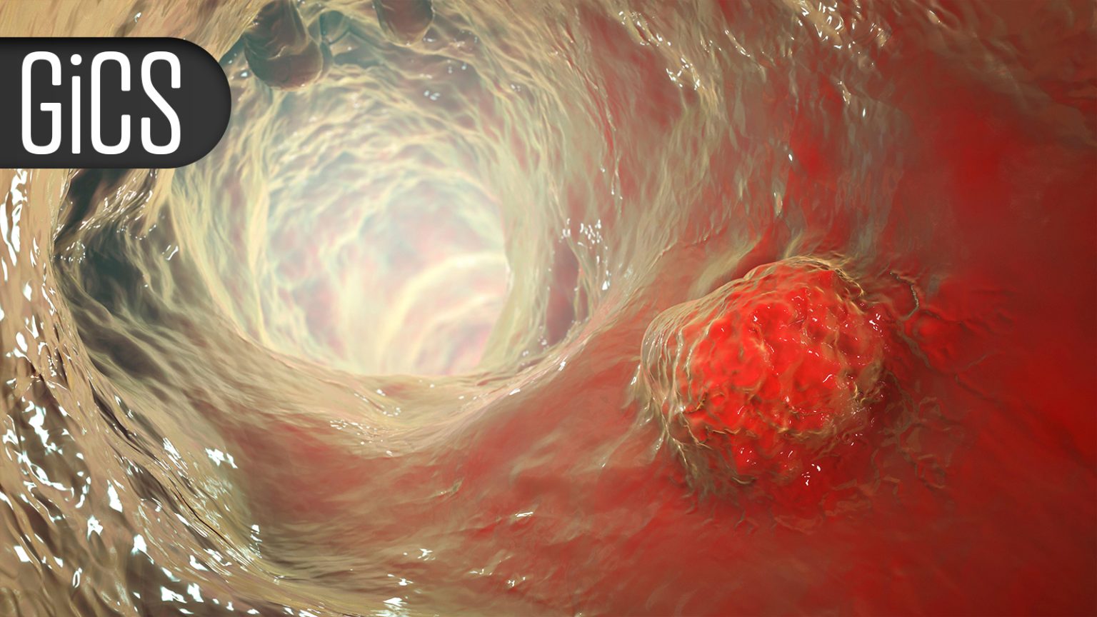 Immuno-Oncology Tops Embolization for Intermediate-Grade Liver Cancer