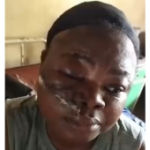 Police Tear Gas Canister Hits APC Women Leader In Kogi Community, Leaves Severe Facial Injuries